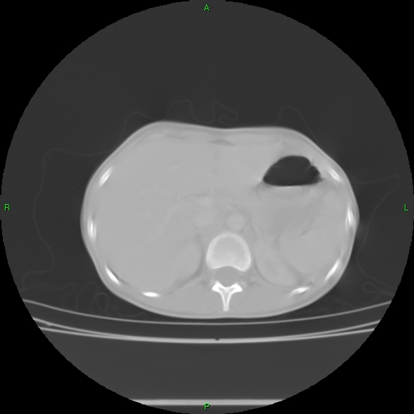 File:Cannon ball metastases - synovial sarcoma (Radiopaedia 26135-26271 Axial lung window 37).jpg