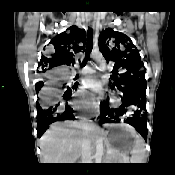 File:Cannon ball metastases - synovial sarcoma (Radiopaedia 26135-26271 Coronal liver window 9).jpg