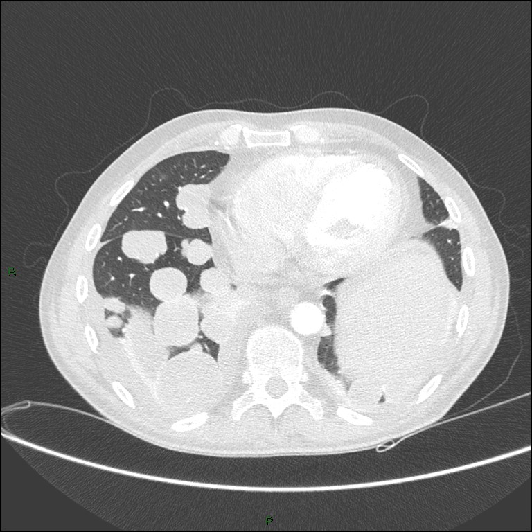Cannonball metastases (Radiopaedia 82110-96150 Axial lung window 143).jpg