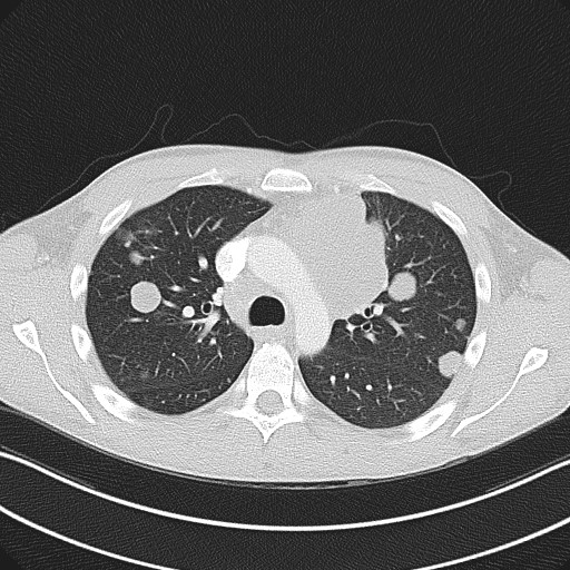 Cannonball metastases - testicular choriocarcinoma (Radiopaedia 84510-99891 Axial lung window 36).jpg