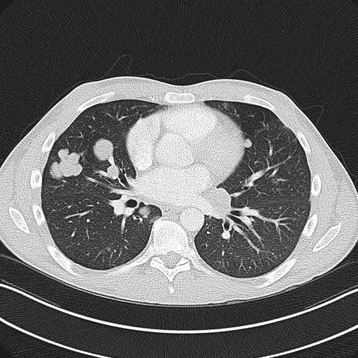 File:Cannonball metastases - testicular choriocarcinoma (Radiopaedia 84510-99891 Axial lung window 55).jpg