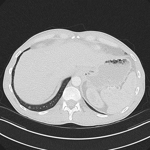 Cannonball metastases - testicular choriocarcinoma (Radiopaedia 84510-99891 Axial lung window 85).jpg