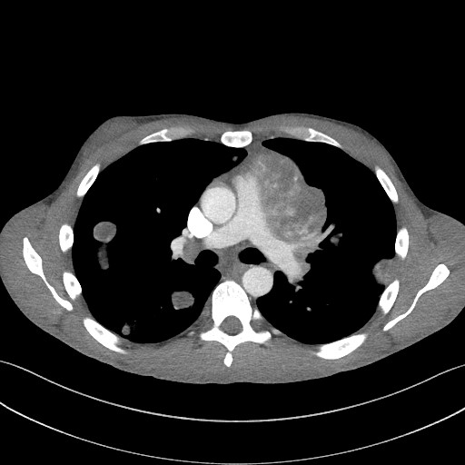 Cannonball metastases - testicular choriocarcinoma (Radiopaedia 84510-99891 B 54).jpg