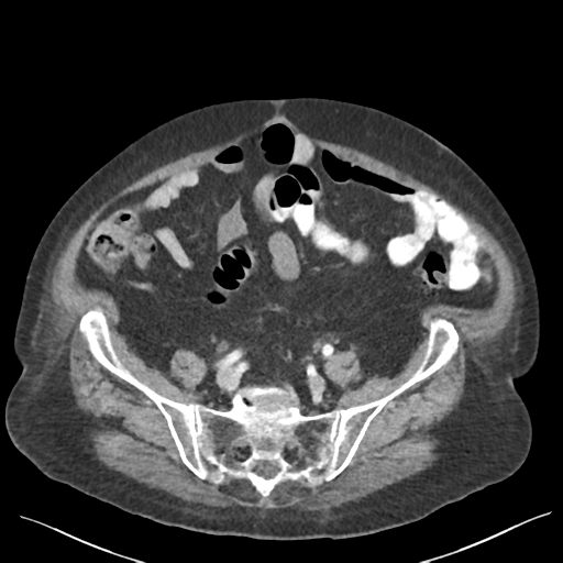Cannonball metastases from endometrial cancer (Radiopaedia 42003-45031 E 56).png