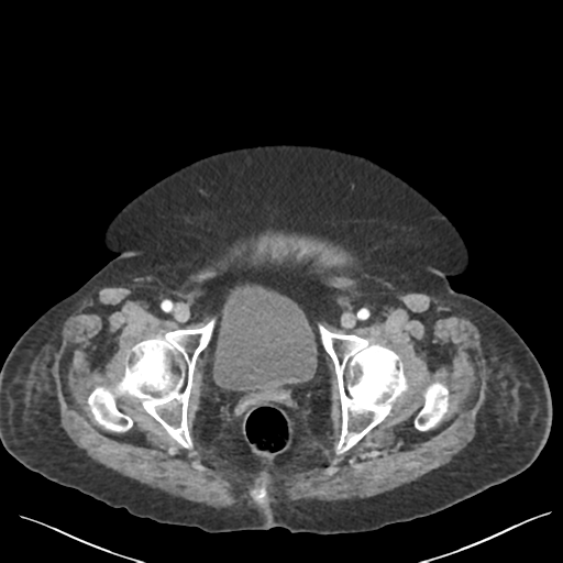 Cannonball metastases from endometrial cancer (Radiopaedia 42003-45031 E 72).png