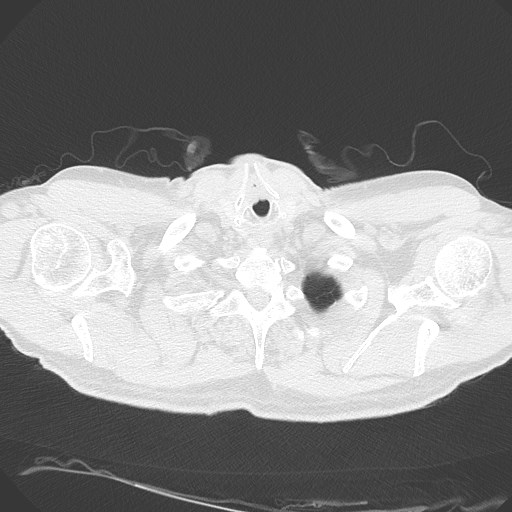 Caplan syndrome (Radiopaedia 56667-63530 Axial lung window 15).jpg