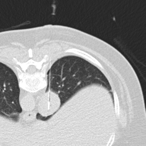 File:Carcinoid tumor - lung (Radiopaedia 44814-48644 Axial lung window 91).png