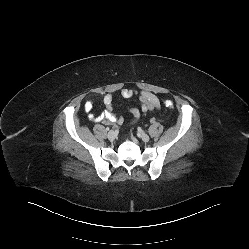 File:Carcinoid tumor - terminal ileum (Radiopaedia 60931-68739 Axial 58).jpg