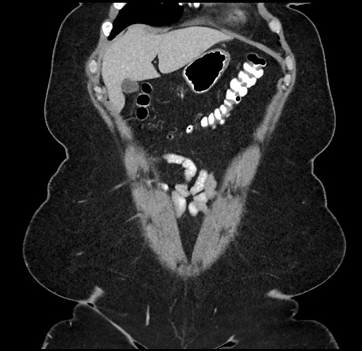 File:Carcinoid tumor - terminal ileum (Radiopaedia 60931-68739 B 6).jpg