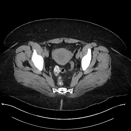 Carcinoid tumor - terminal ileum (Radiopaedia 60931-68740 Axial non-contrast 108).jpg