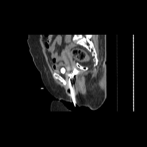 Carcinoma cervix- brachytherapy applicator (Radiopaedia 33135-34173 D 77).jpg