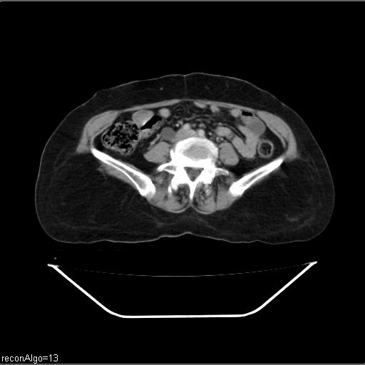 File:Carcinoma cervix- recurrence (Radiopaedia 34702-36137 B 34).jpg