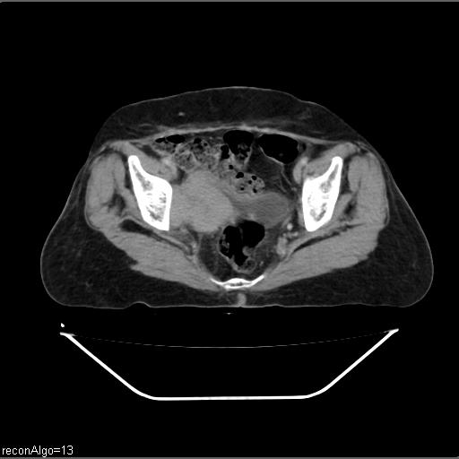 Carcinoma cervix- recurrence (Radiopaedia 34702-36137 B 46).jpg