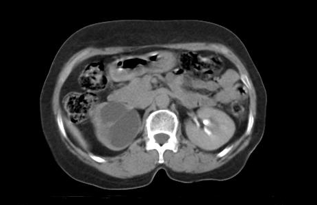 File:Carcinoma cervix - recurrence (Radiopaedia 34702-36137 Axial 108).png