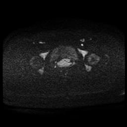 Carcinoma of the cervix (Radiopaedia 89018-105858 Axial DWI 70).jpg