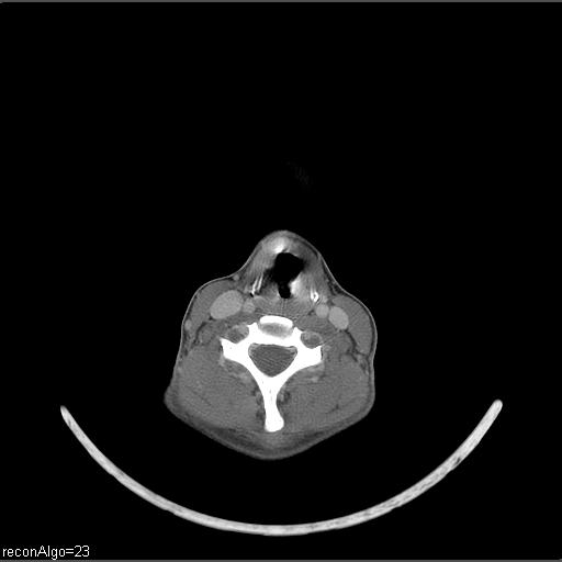 Carcinoma of the maxillary antrum (Radiopaedia 53805-59888 Axial C+ delayed 18).jpg