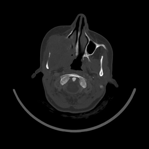 Carcinoma of the maxillary antrum (Radiopaedia 53805-59888 Axial bone window 59).jpg