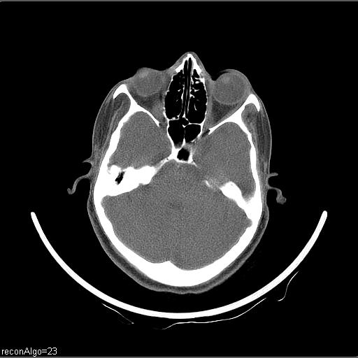Carcinoma of the maxillary antrum (Radiopaedia 53805-59888 Axial non-contrast 71).jpg