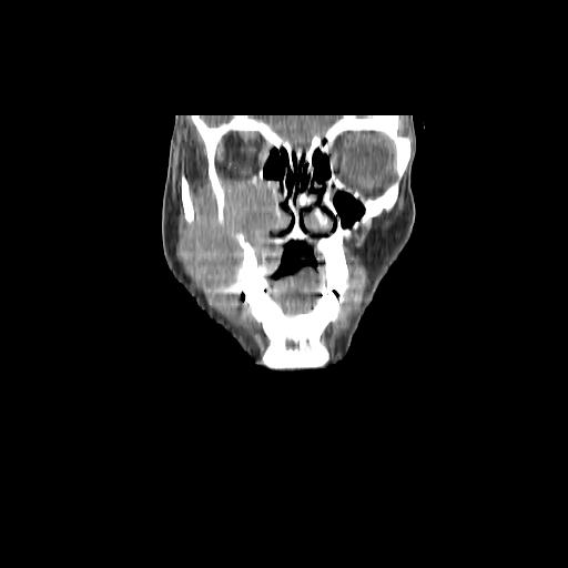 File:Carcinoma of the maxillary antrum (Radiopaedia 53805-59888 Coronal C+ delayed 30).jpg