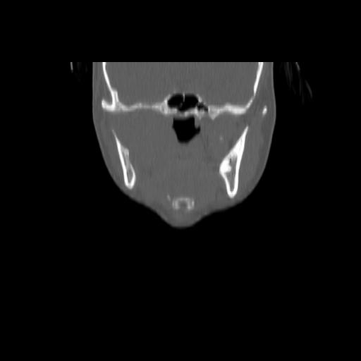 Carcinoma of the maxillary antrum (Radiopaedia 53805-59888 Coronal bone window 66).jpg