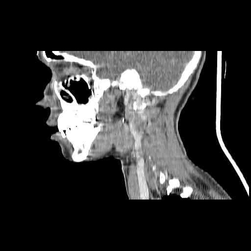 Carcinoma of the maxillary antrum (Radiopaedia 53805-59888 Sagittal C+ delayed 122).jpg