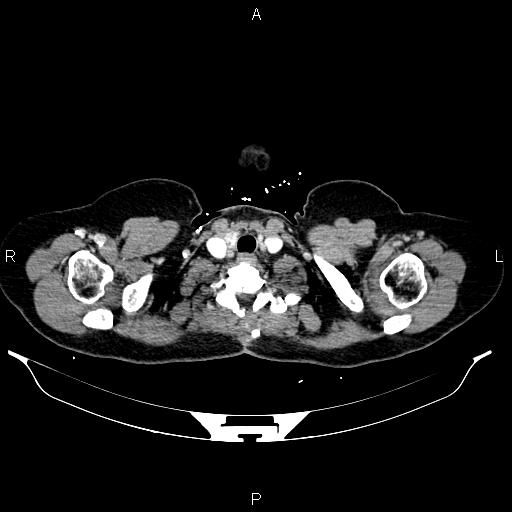 File:Carcinoma of uterine cervix (Radiopaedia 85861-101700 A 5).jpg