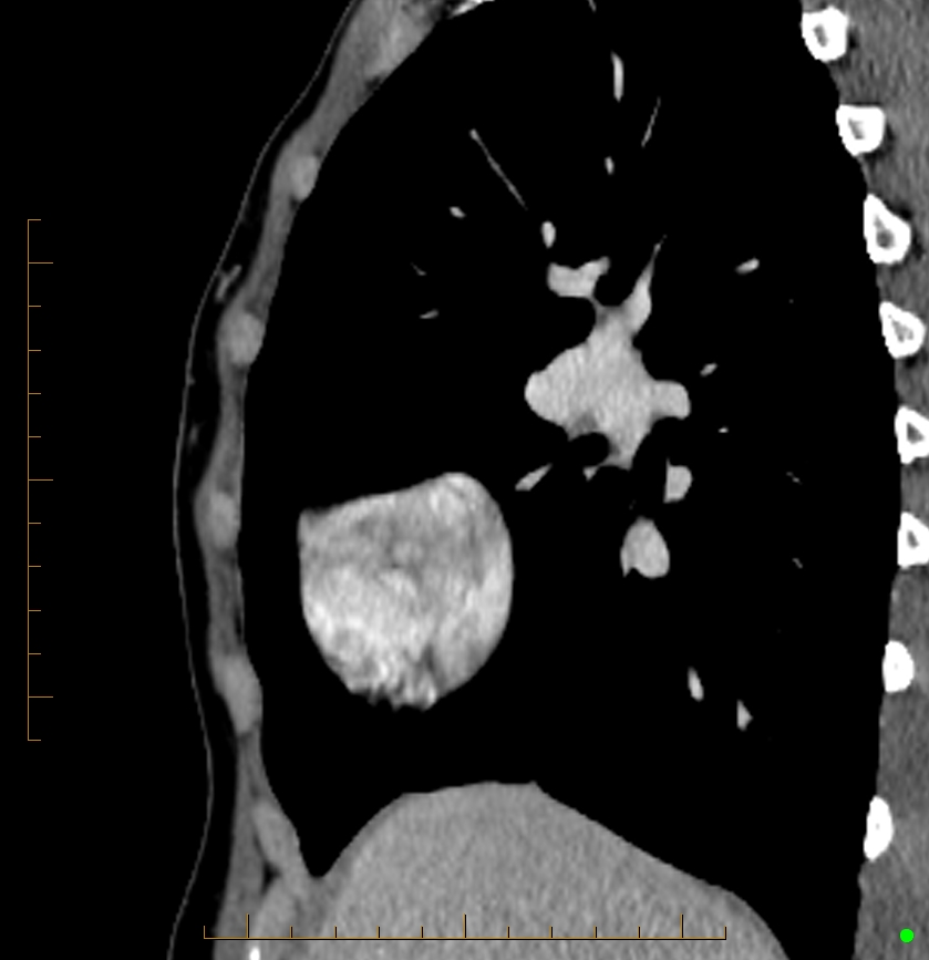 Cardiac paraganglioma (Radiopaedia 76345-88005 C 90).jpg