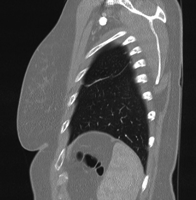 Cardiac sarcoidosis (Radiopaedia 74548-85534 Sagittal lung window 10).jpg