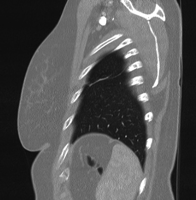 Cardiac sarcoidosis (Radiopaedia 74548-85534 Sagittal lung window 9).jpg