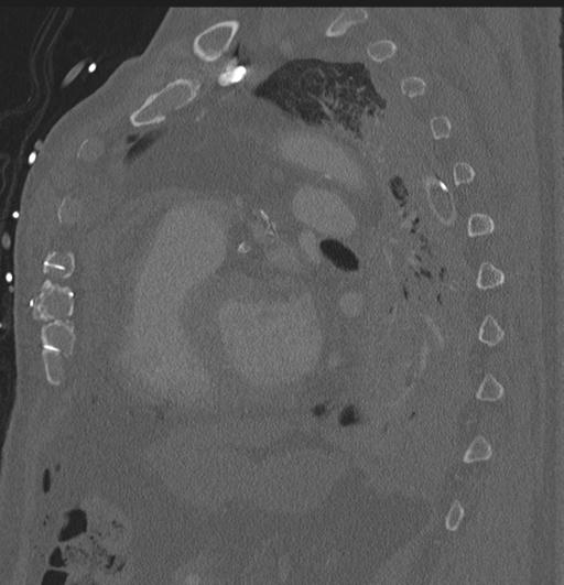 Cardiac trauma (Radiopaedia 32874-33858 Sagittal bone window 13).jpg