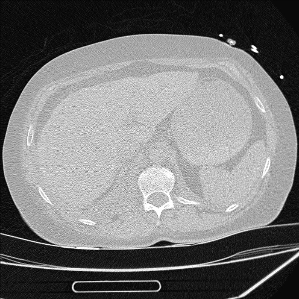 Cardiogenic pulmonary edema (Radiopaedia 29213-29609 Axial lung window 105).jpg