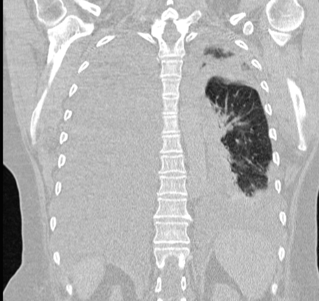 Cardiogenic pulmonary edema (Radiopaedia 29213-29609 Coronal lung window 49).jpg