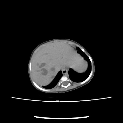 Caroli disease with autosomal recessive polycystic kidney disease (ARPKD) (Radiopaedia 89651-106703 E 26).jpg
