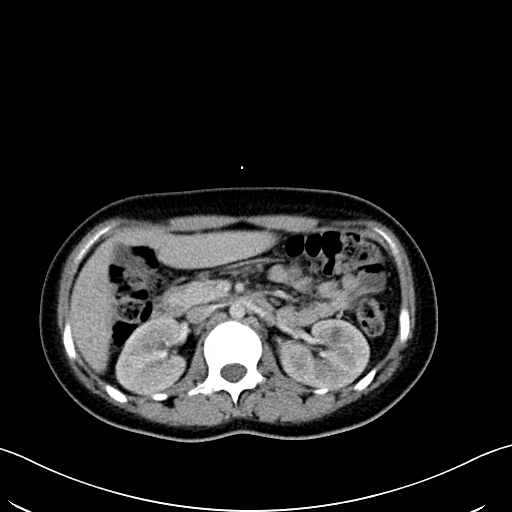 Caroli disease with medullary sponge kidney (Radiopaedia 82622-96804 C 28).jpg