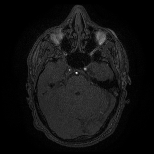 File:Carotid arterial dissection with acute cerebral infarction (Radiopaedia 26636-26784 MRA 121).jpg
