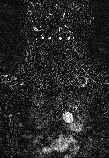 Carotid artery dissection (Radiopaedia 28441-28689 Coronal MRA 78).jpg