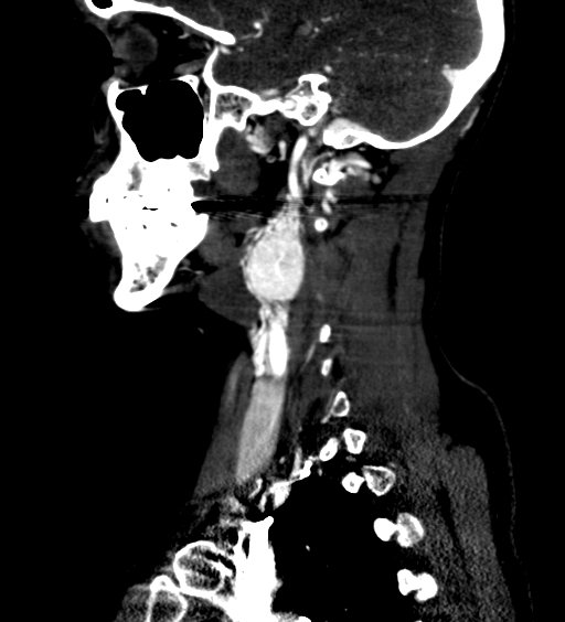 File:Carotid body tumor (Radiopaedia 39845-42300 D 38).jpg