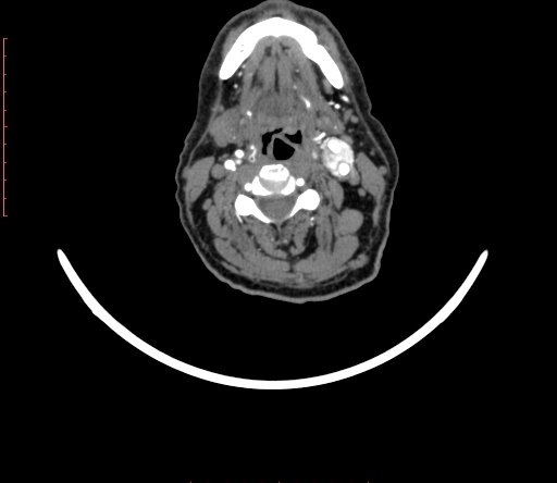 Carotid body tumor (Radiopaedia 66785-76116 B 42).jpg