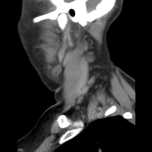 File:Carotid body tumor (paraganglioma) (Radiopaedia 38586-40729 C 24).jpg