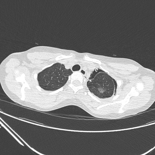 Catamenial pneumothorax (Radiopaedia 27946-28197 lung window 34).jpg