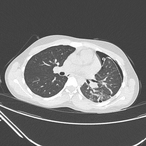 Catamenial pneumothorax (Radiopaedia 27946-28197 lung window 77).jpg