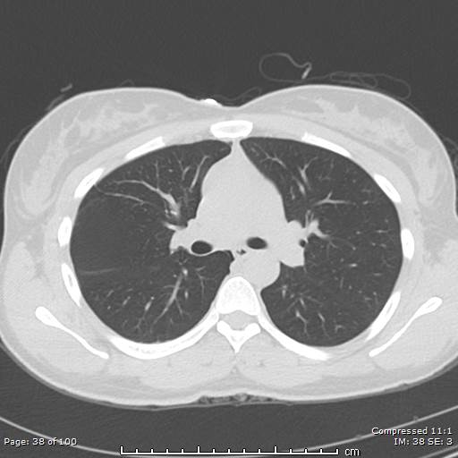 Catamenial pneumothorax (Radiopaedia 54382-60600 Axial non-contrast 38).jpg