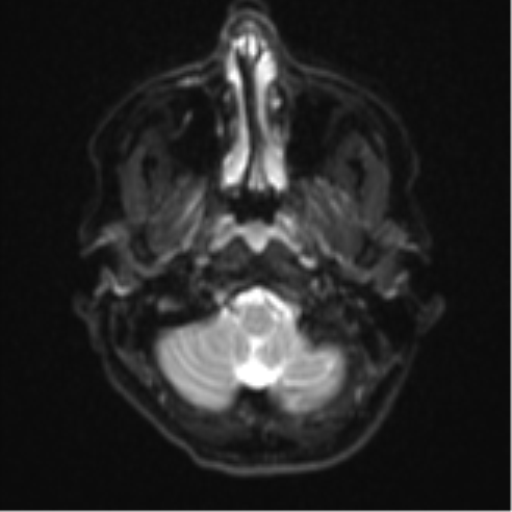File:Cavernoma with bleed - midbrain (Radiopaedia 54546-60774 Axial DWI 2).png