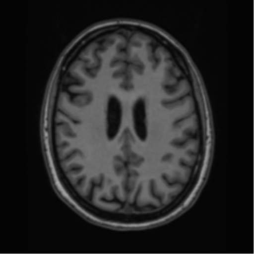 Cavernoma with bleed - midbrain (Radiopaedia 54546-60774 Axial T1 34).png