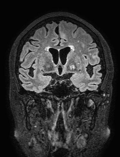 Cavernous hemangioma of the cerebellar falx (Radiopaedia 73025-83724 Coronal FLAIR 146).jpg