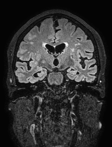 Cavernous hemangioma of the cerebellar falx (Radiopaedia 73025-83724 Coronal FLAIR 169).jpg