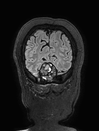 Cavernous hemangioma of the cerebellar falx (Radiopaedia 73025-83724 Coronal FLAIR 320).jpg