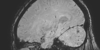 Cavernous hemangioma of the cerebellar falx (Radiopaedia 73025-83724 Sagittal BOLD 144).jpg