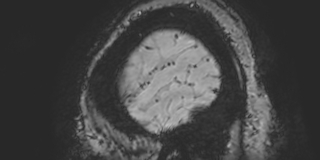 Cavernous hemangioma of the cerebellar falx (Radiopaedia 73025-83724 Sagittal BOLD 191).jpg