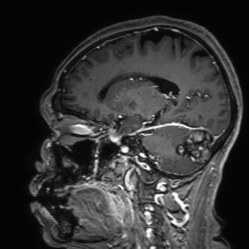Cavernous hemangioma of the cerebellar falx (Radiopaedia 73025-83724 Sagittal T1 C+ 132).jpg